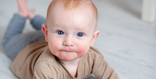 Baby med atopisk eksem