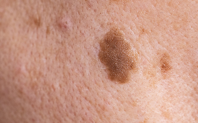 skummel f&oslash;flekk, sjekk